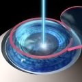 LASIK Eye Surgery